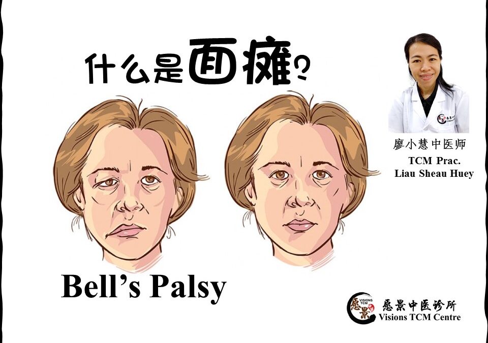 面瘫（学名：面神经麻痹）【廖小慧医师】