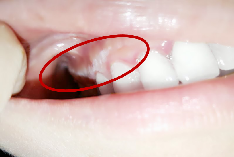 Mouth Ulcer 1