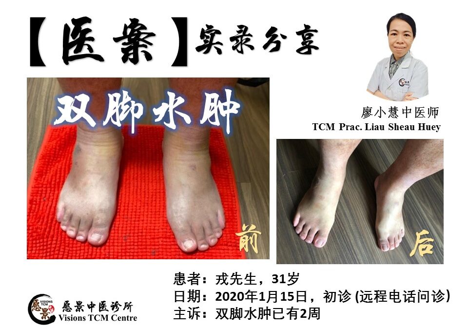 【医案实录】双脚水肿已两周 – 廖小慧医师