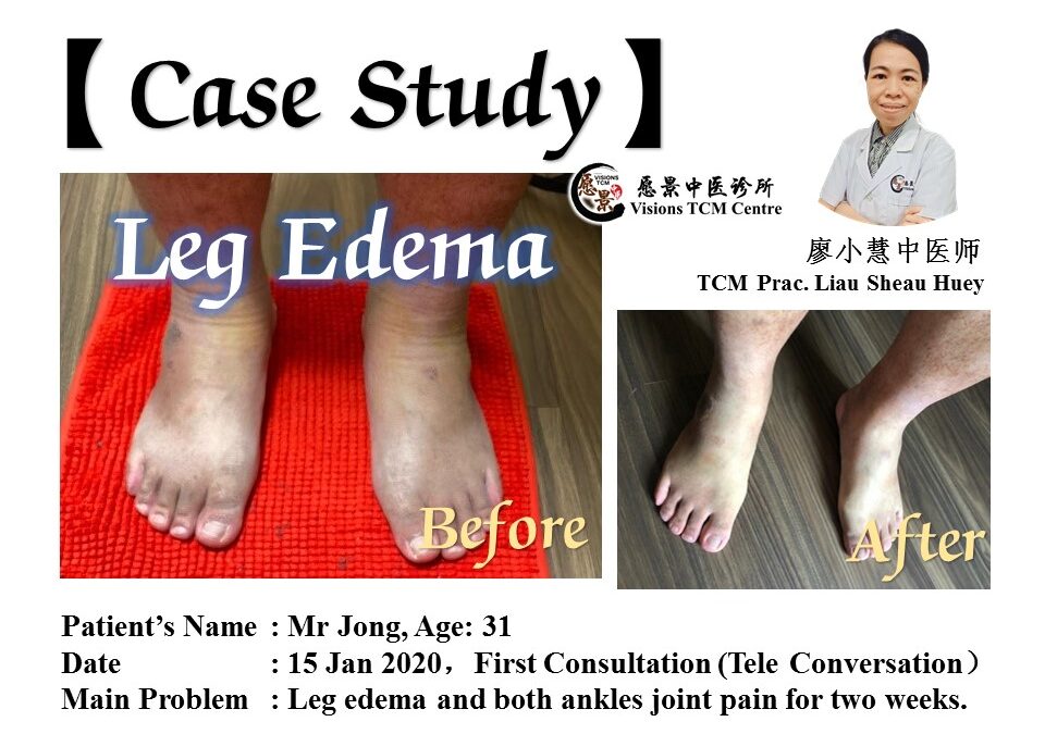 Case Study – Leg edema 【TCM Prac. Liau】