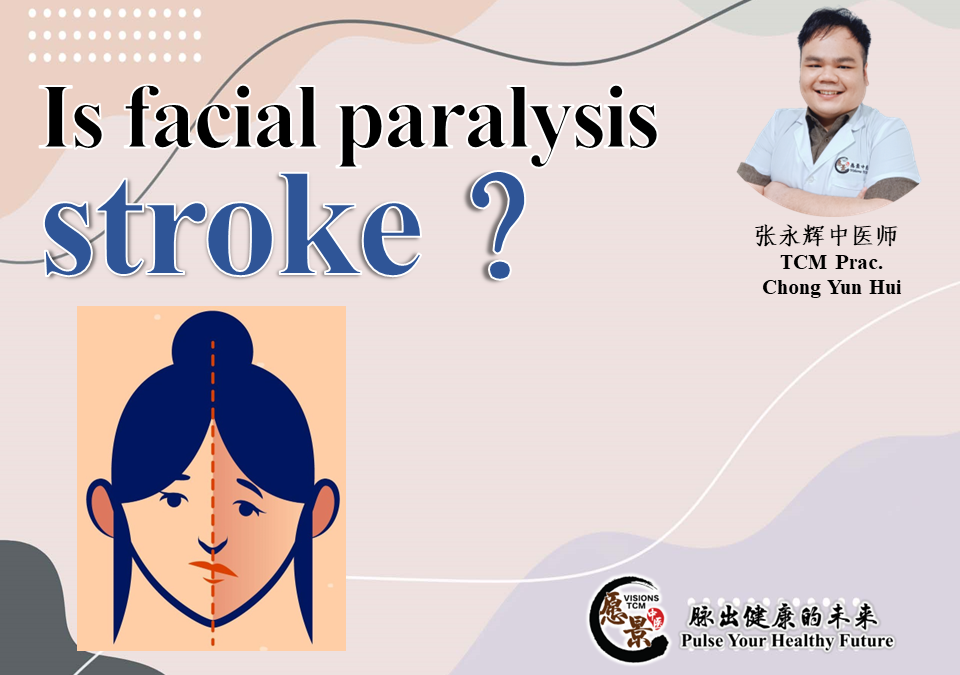 Is facial paralysis stroke?