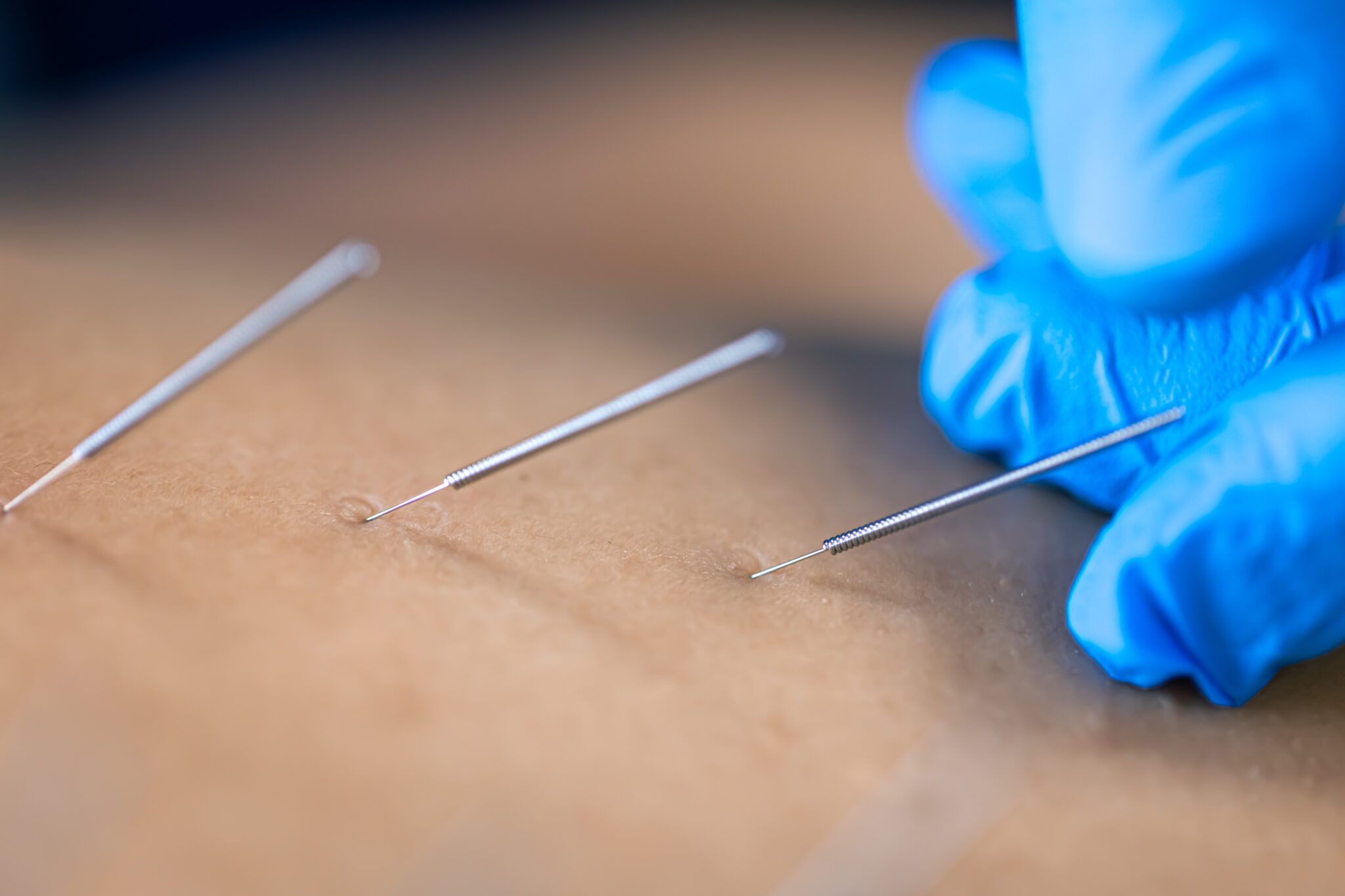 中医针灸 - 王爱莲医师 - 愿景中医 Visions TCM