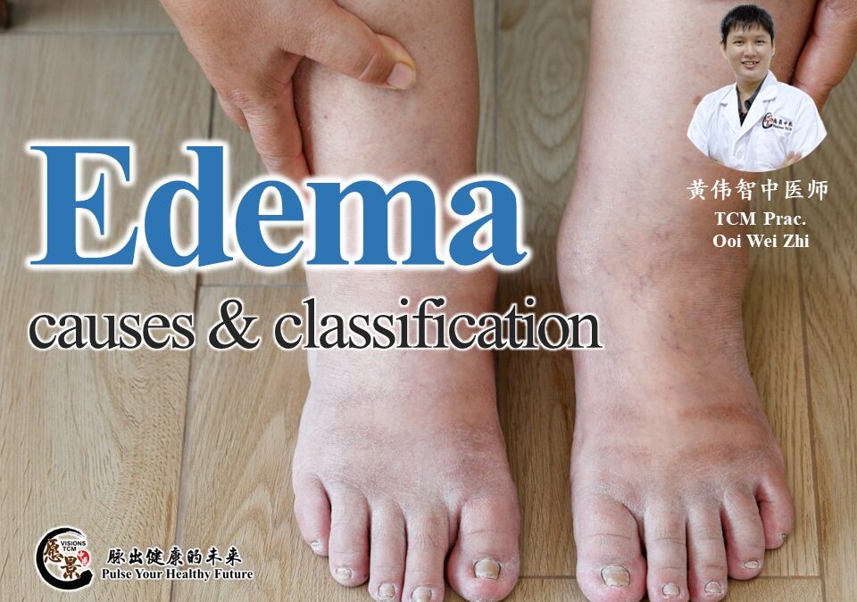 Causes and Classification of Edema