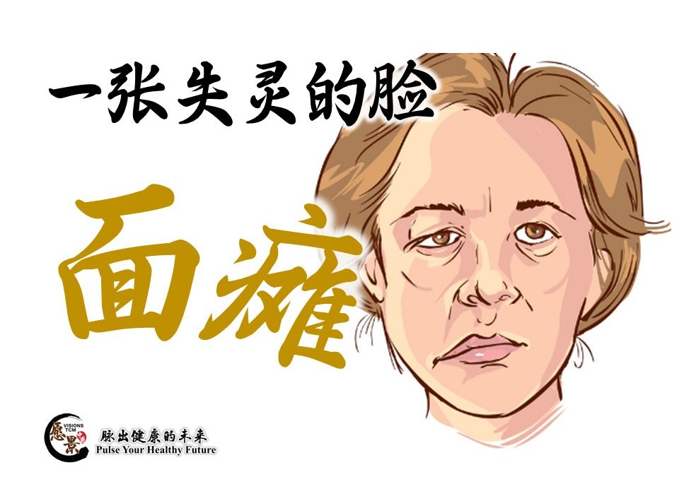 一张表情失灵的脸-面瘫