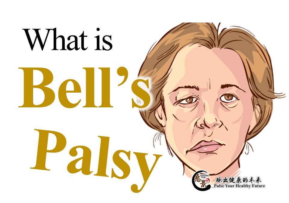 A Face that Loses Control – Bell’s Palsy