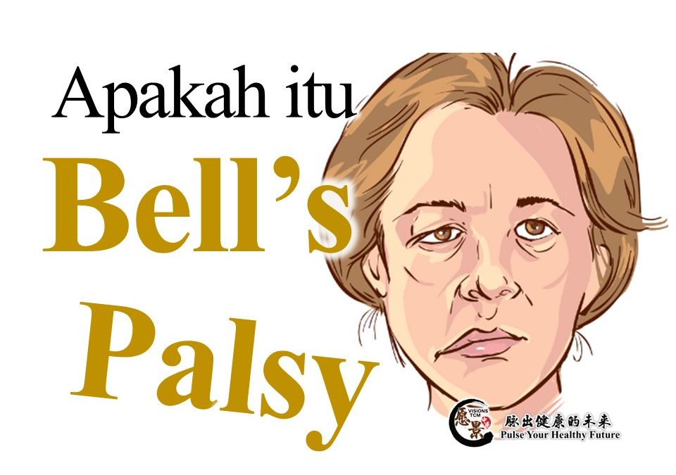 Muka Lumpuh yang Disebabkan oleh Bell’s Palsy